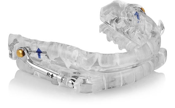 snore device | Serenity Valley Dental