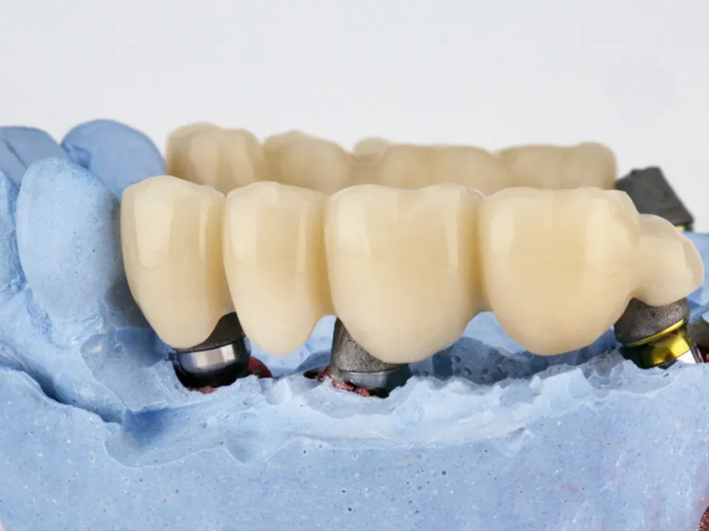 dental implants