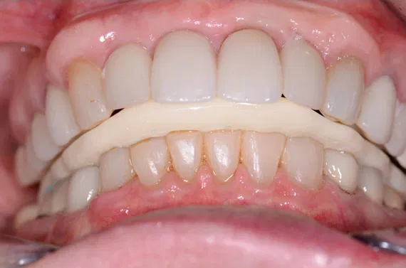 svdental-anatomical-splint
