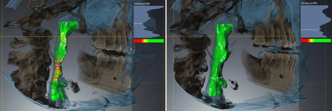 svdental cbct before after c - Serenity Valley Family Dentistry