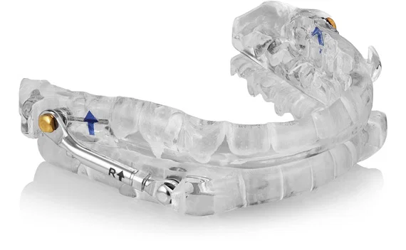 svdental snore device01 - Serenity Valley Family Dentistry