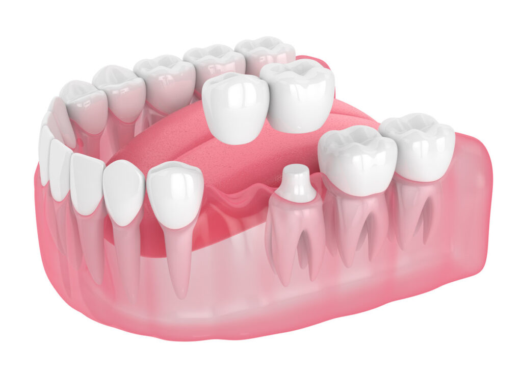 3d render of jaw with cantilever bridge isolated over white background