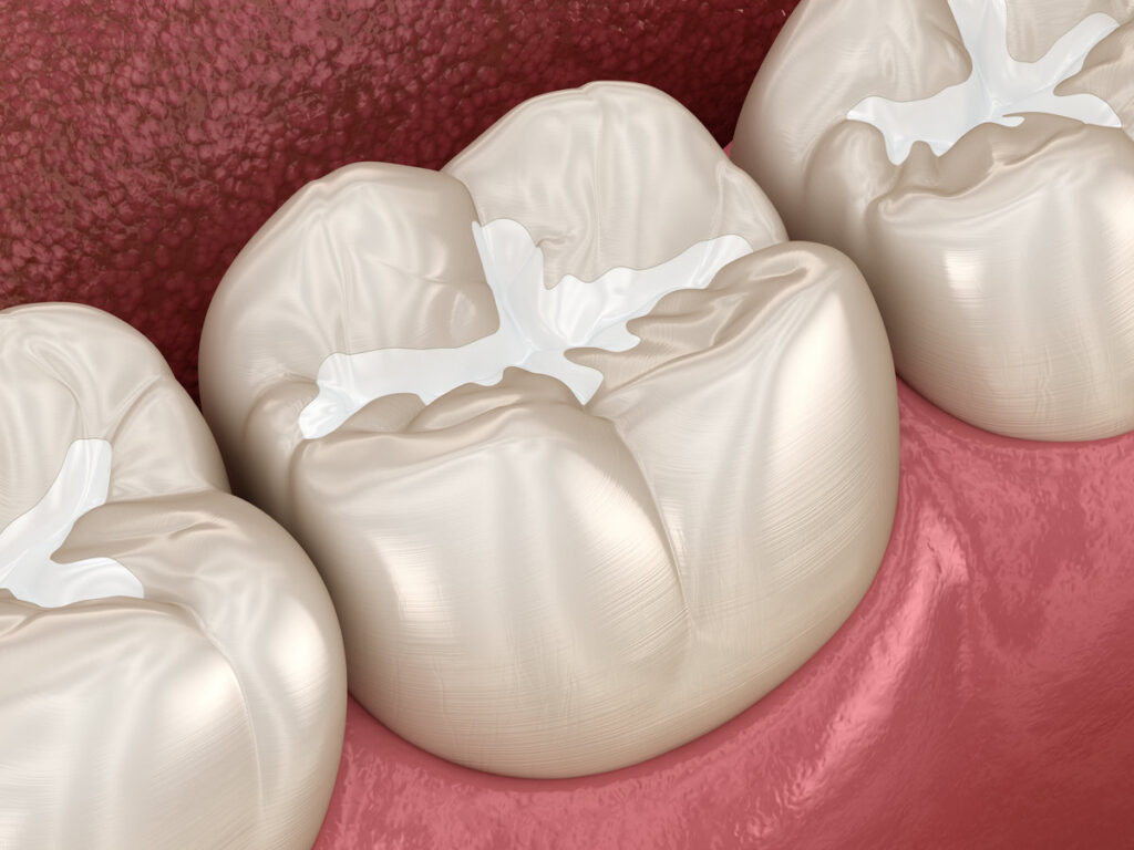 Molar Fissure dental fillings, Medically accurate 3D illustration of dental concept