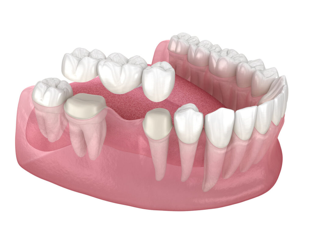 Dental bridge of 3 teeth over molar and premolar. Medically accurate 3D illustration of human teeth treatment